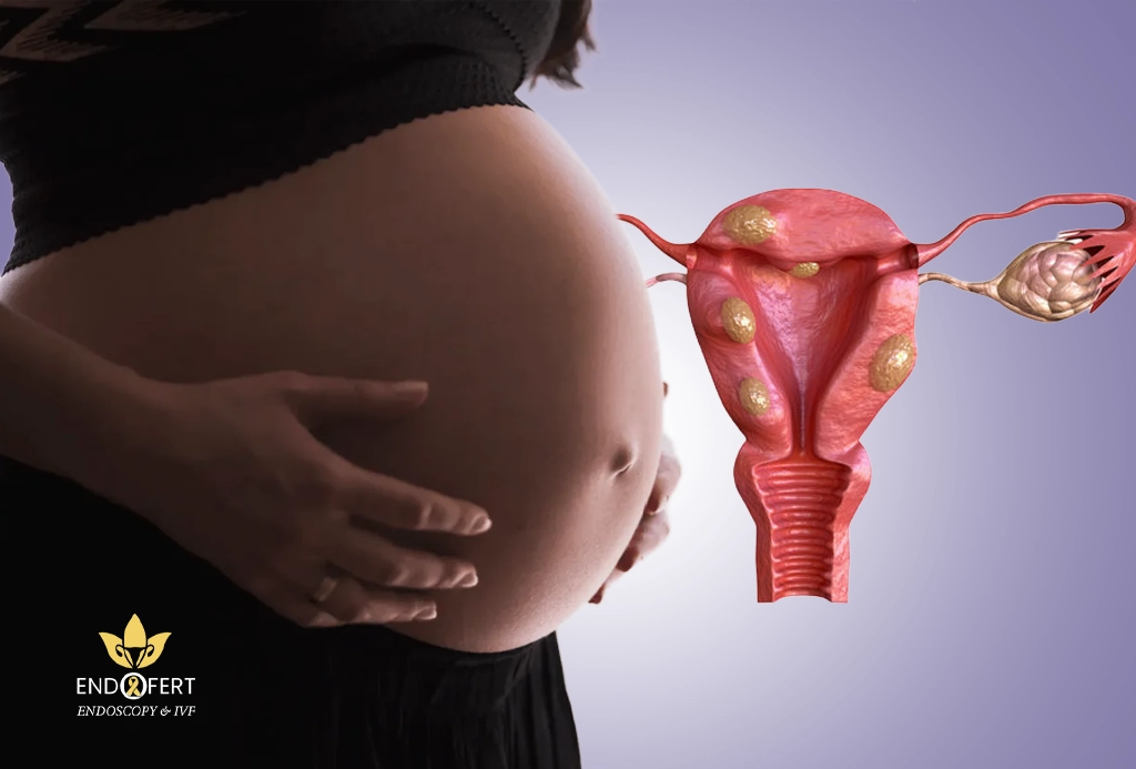 تأخر-الإنجاب-الناتج-عن-بطانة-الرحم-المهاجرة