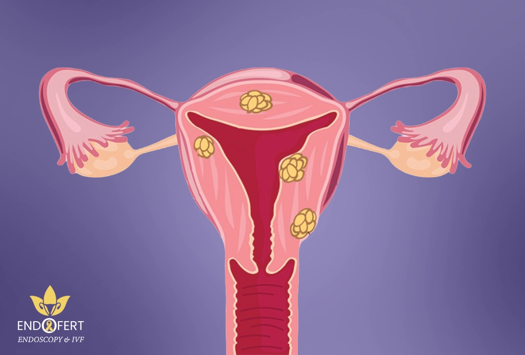 اعراض ما بعد عملية استئصال الورم الليفي؟