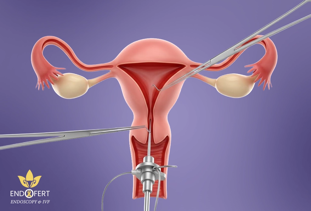 تكلفة عملية استئصال الرحم