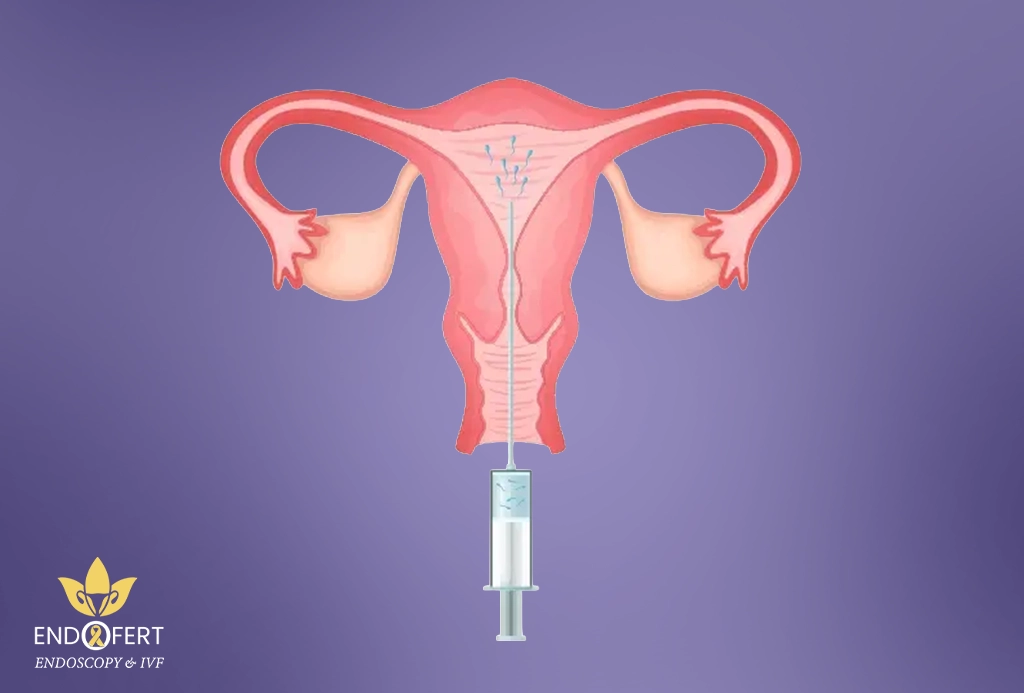 التلقيح-الصناعي