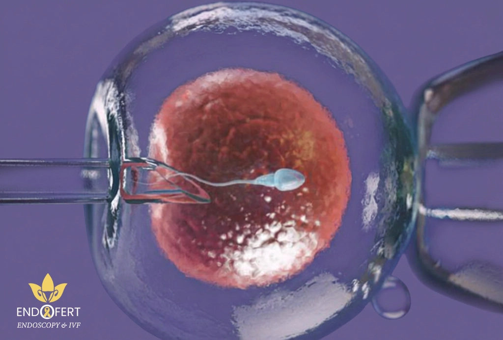 عمليه الحقن المجهري بتتعمل ازاي