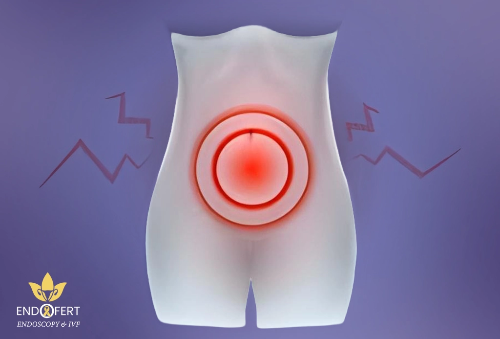 افضل دكتور لعلاج بطانة الرحم المهاجرة