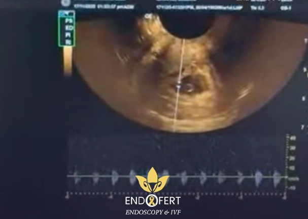 نبض-أمل-بعد-رحلة-حقن-مجهري